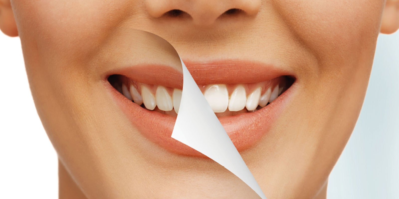 Зубное отбеливание в стоматологии